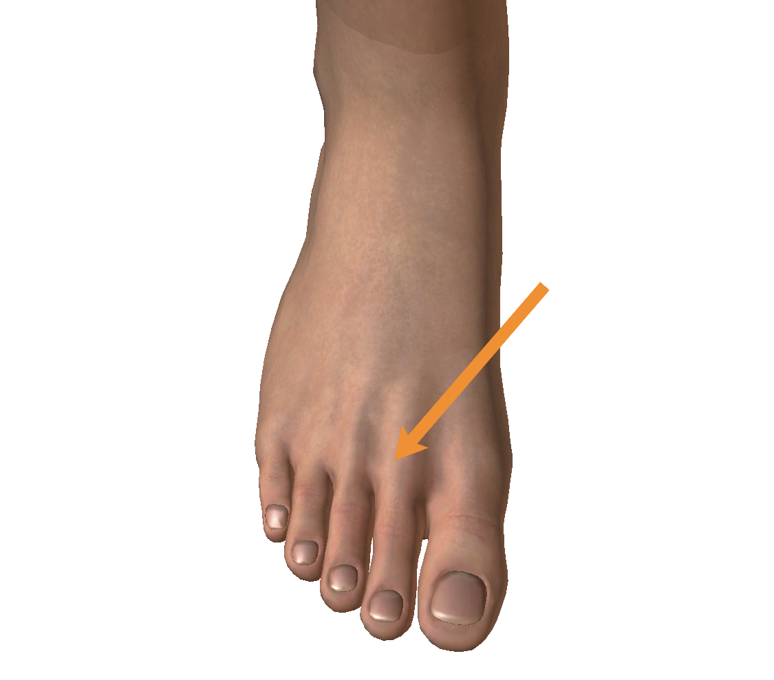 足 の 指 が 痺れる 親指
